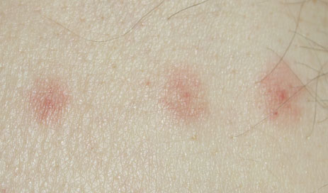 Chiggers red bumps itching